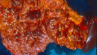 GASTRIC CANCER