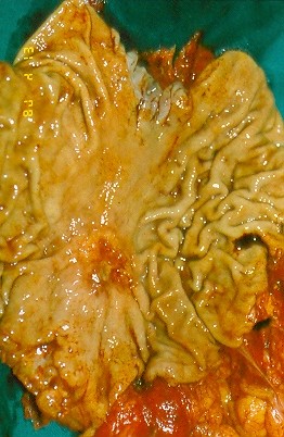 GASTRIC CANCER