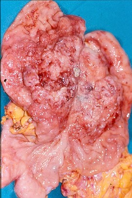 GASTRIC CANCER
