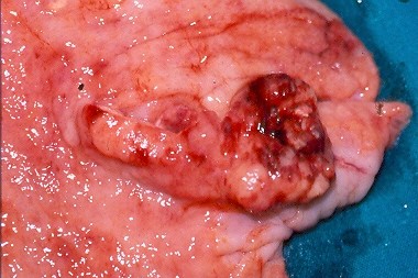 GASTRIC CANCER