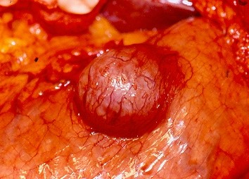GASTRIC LYMPHOMA 
