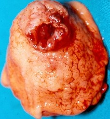 GASTRIC LYMPHOMA
