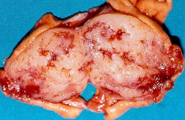 GASTRIC LYMPHOMA