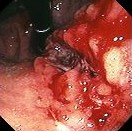 MALIGNANT GASTRIC ULCER
