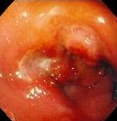MALIGNANT GASTRIC ULCER
