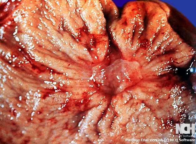 MALIGNANT GASTRIC ULCER