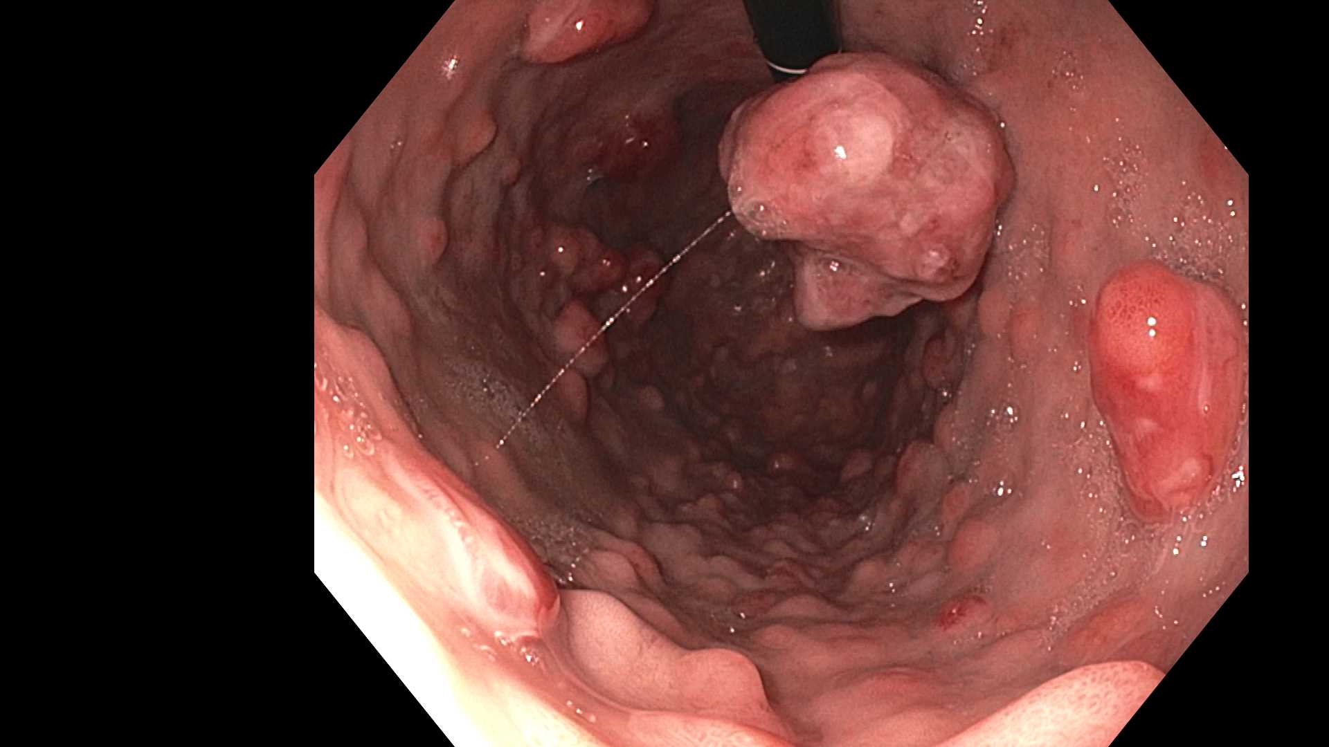 GASTRIC MANEC