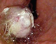 GASTRIC MANEC