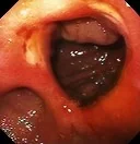 MARGINAL ULCER