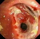 MARGINAL ULCER