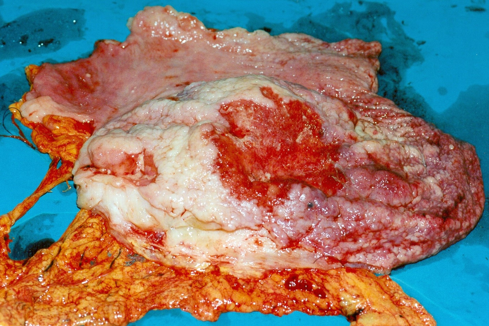 MIXED GASTRIC TUMOR