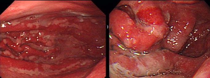 MENETRIER'S DISEASE