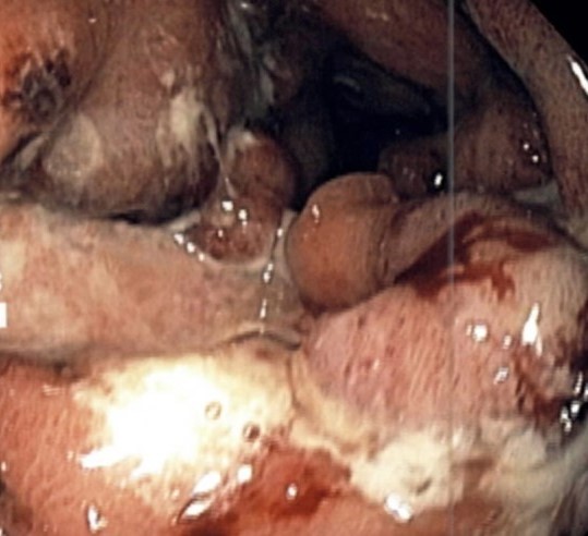 MENETRIER'S DISEASE