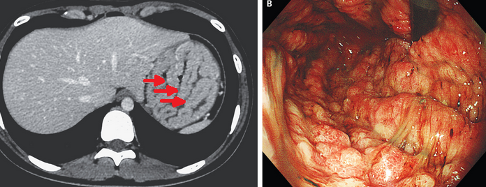 MENETRIER'S DISEASE