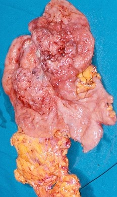 MIXED GASTRIC TUMOR