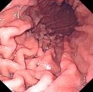 NORMAL STOMACH