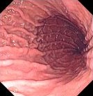 NORMAL STOMACH