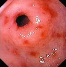 NSAID GASTRITIS