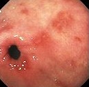 NSAID GASTRITIS