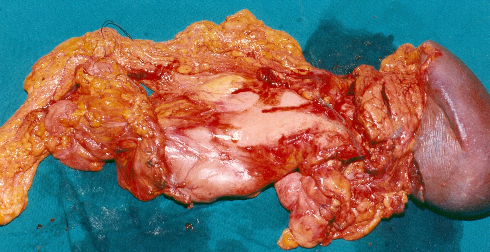 TOTAL GASTRECTOMY - SPLENECTOMY