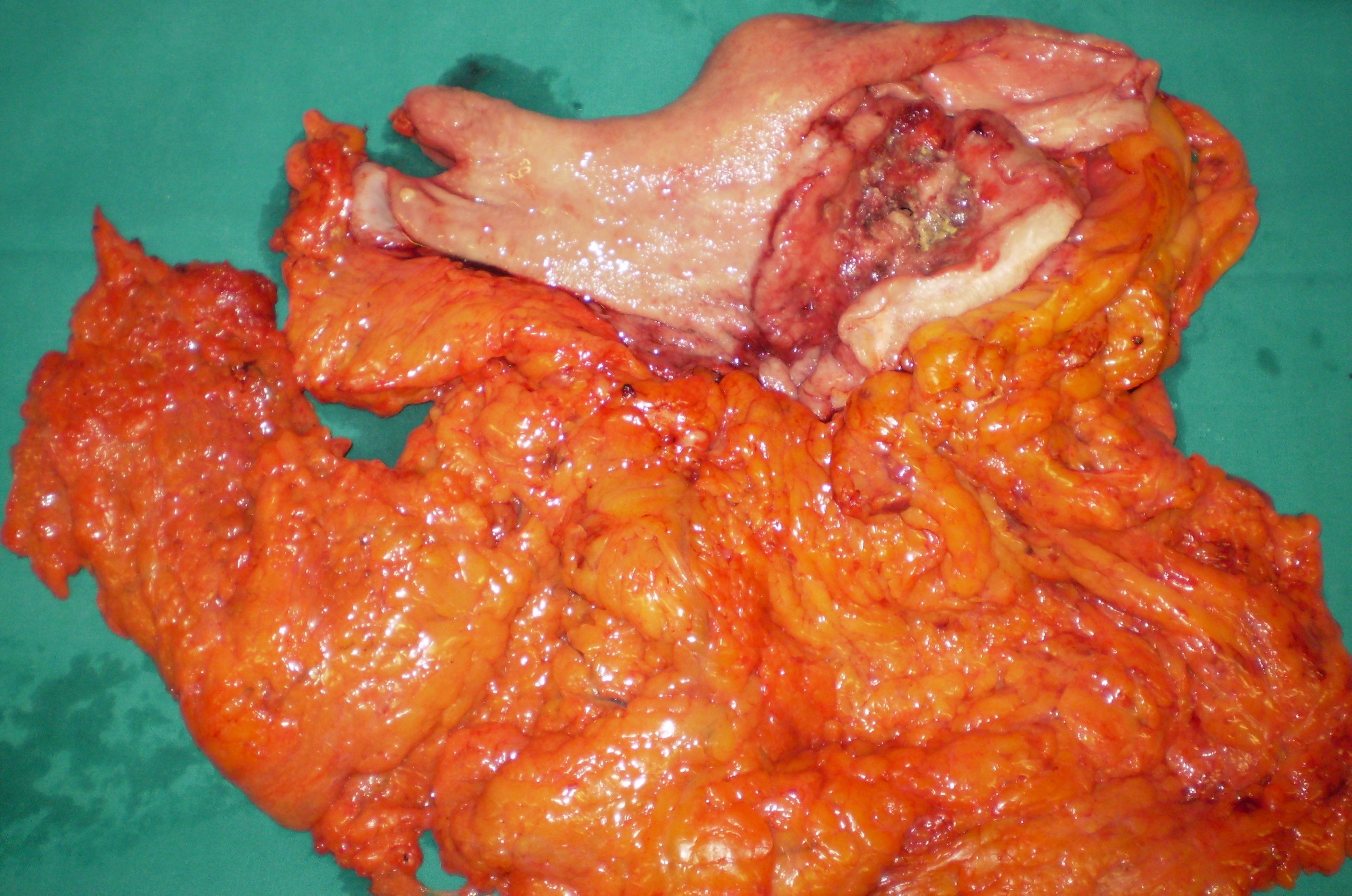 GASTRIC CANCER