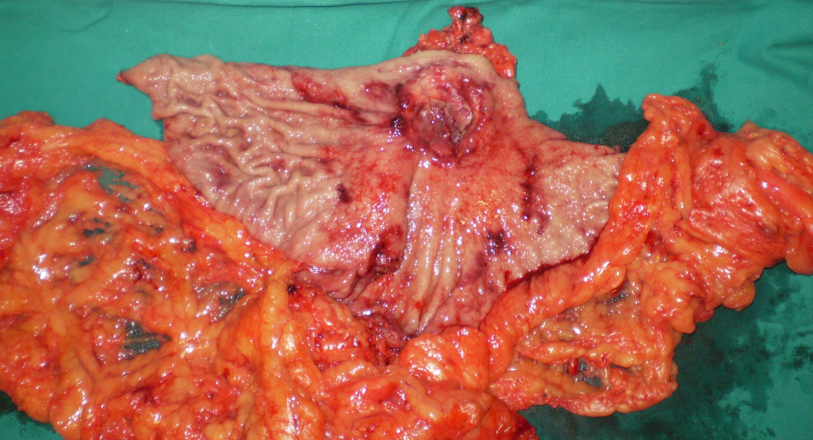 GASTRIC CANCER
