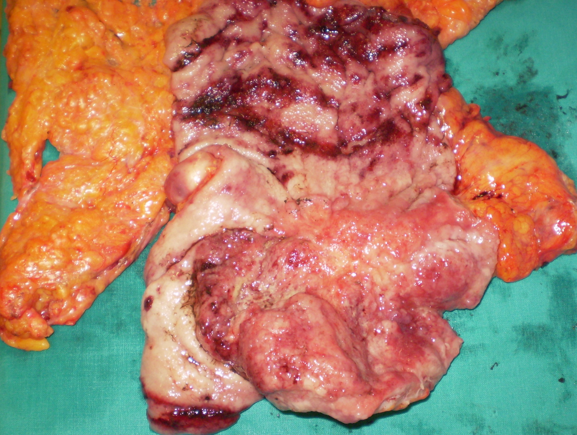 GASTRIC CANCER