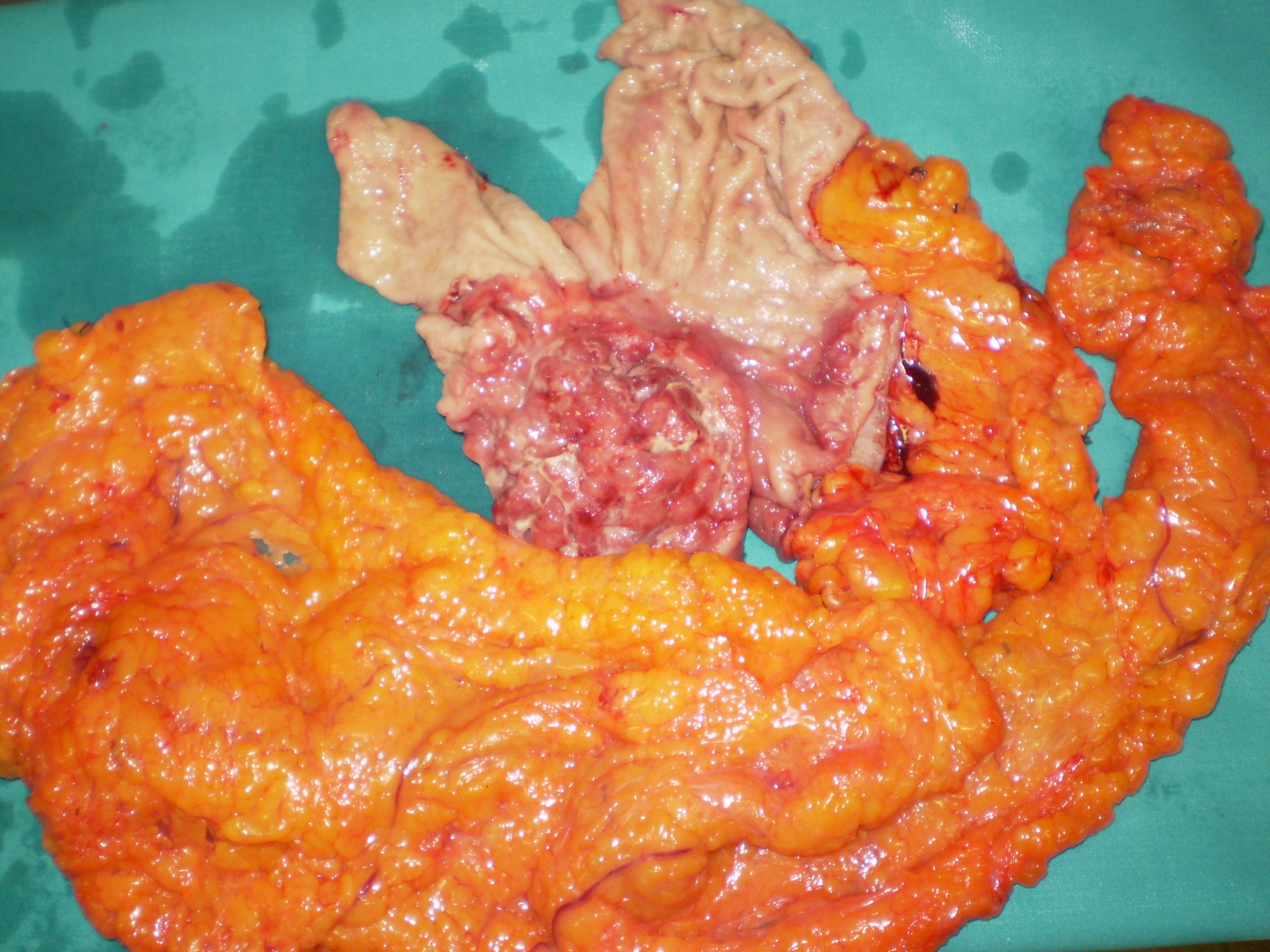 GASTRIC CANCER