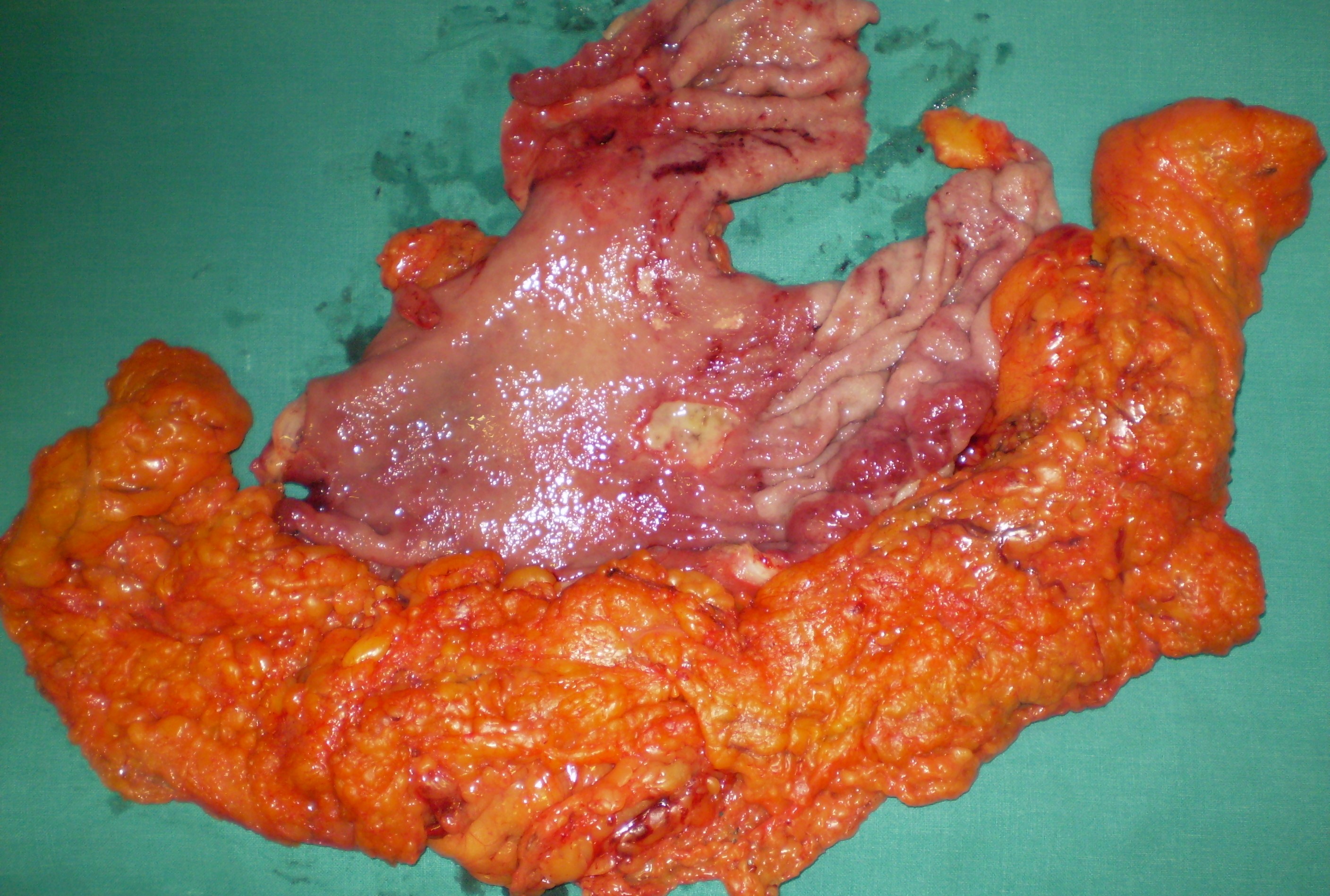GASTRIC CANCER