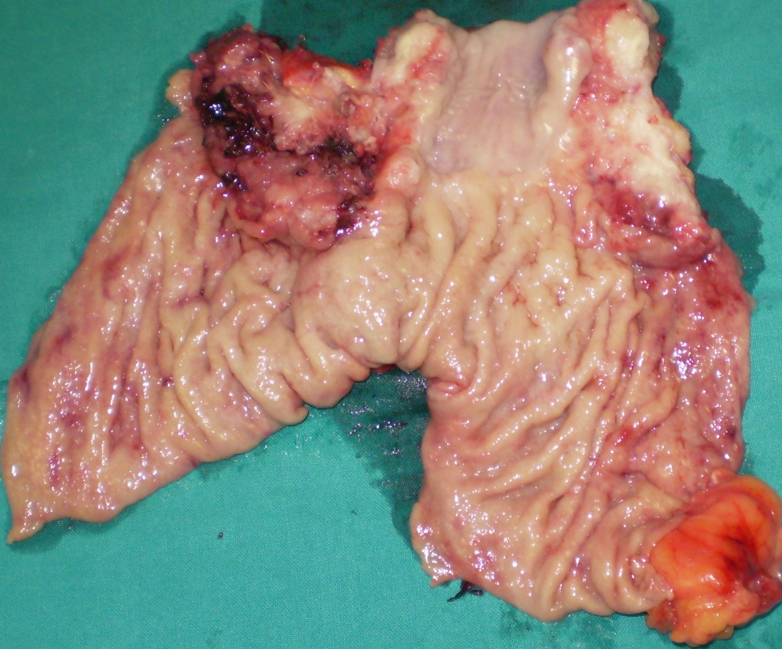 GASTRIC CANCER