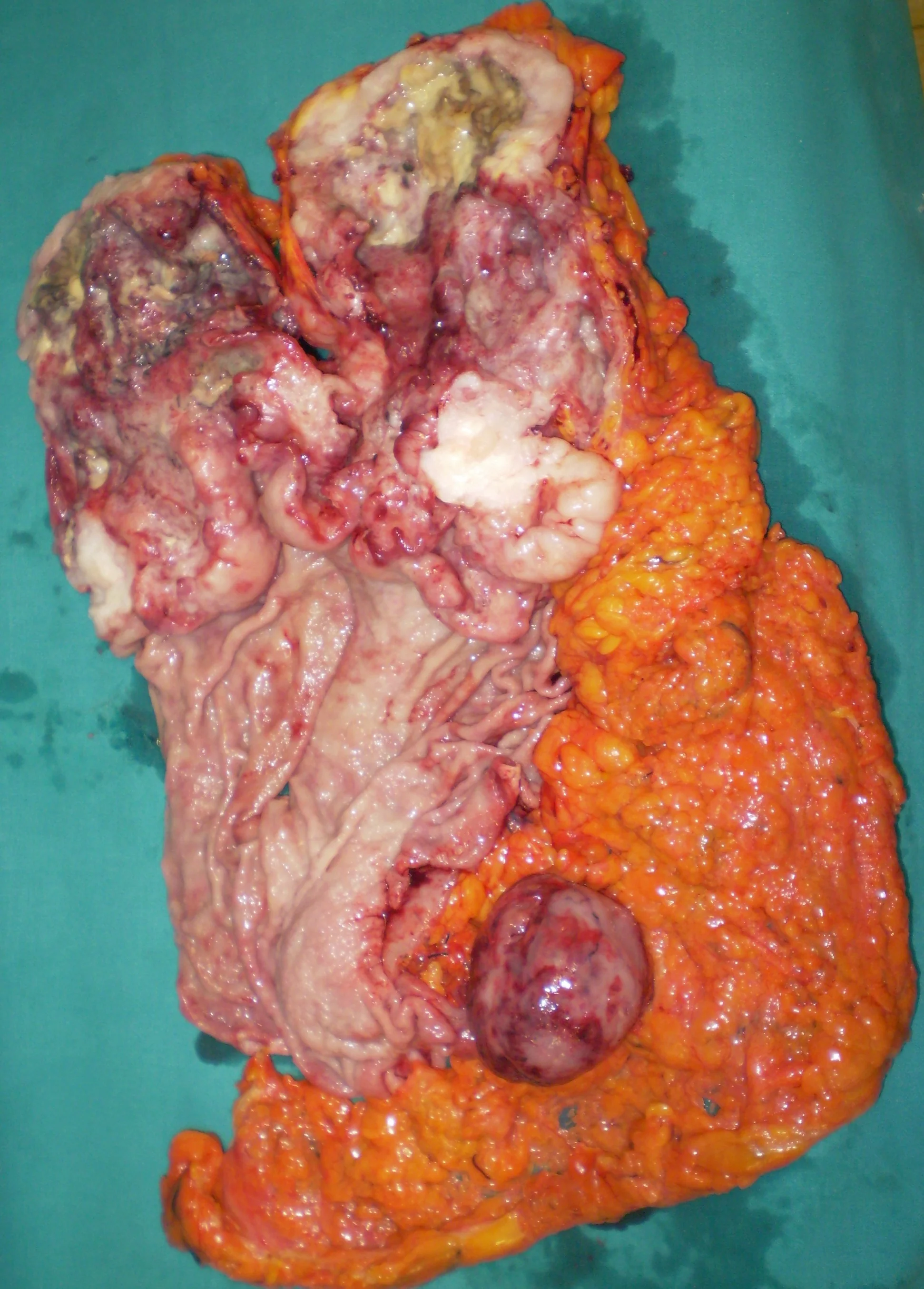 GASTRIC GIST
