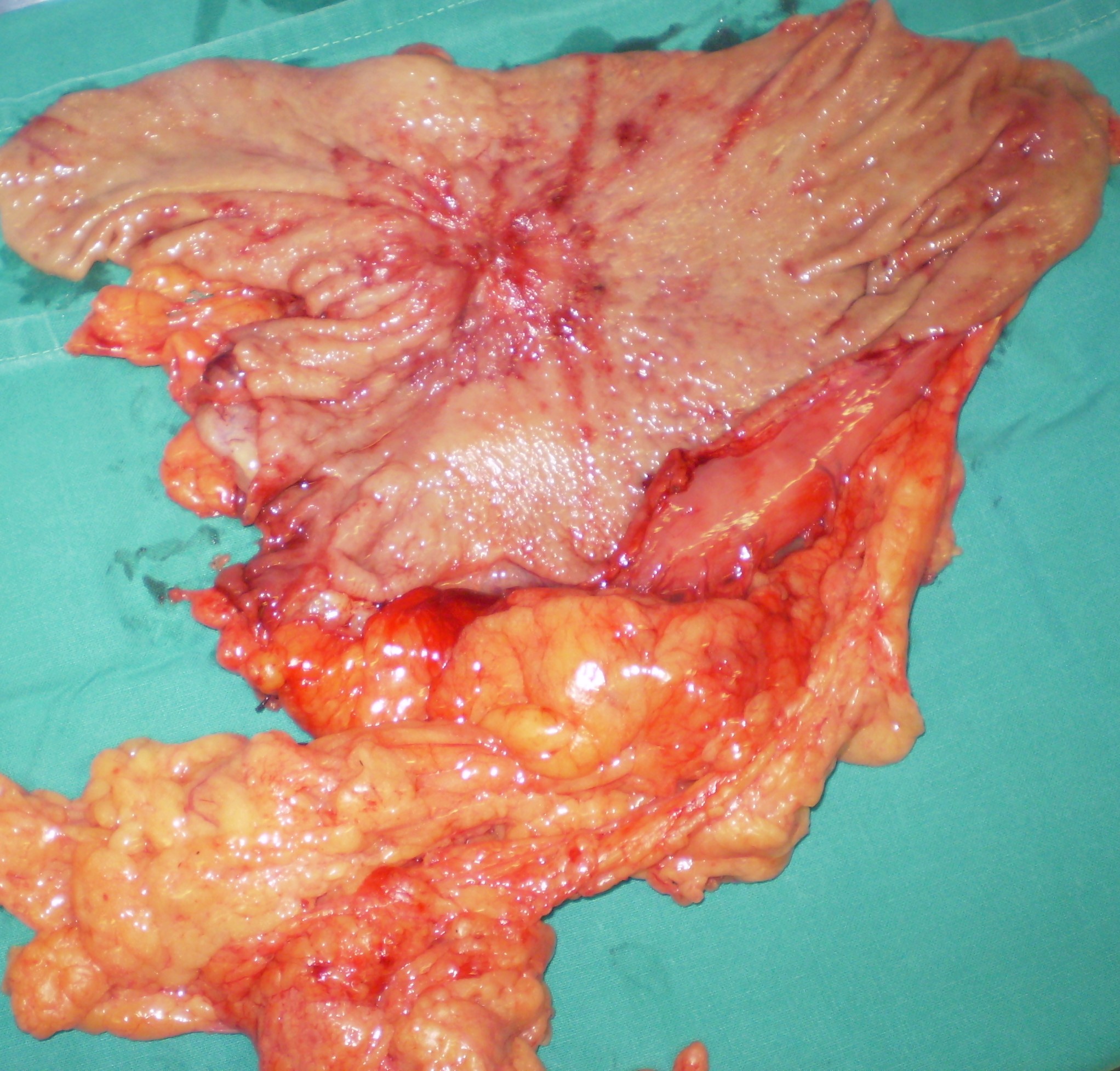 GASTRIC CANCER