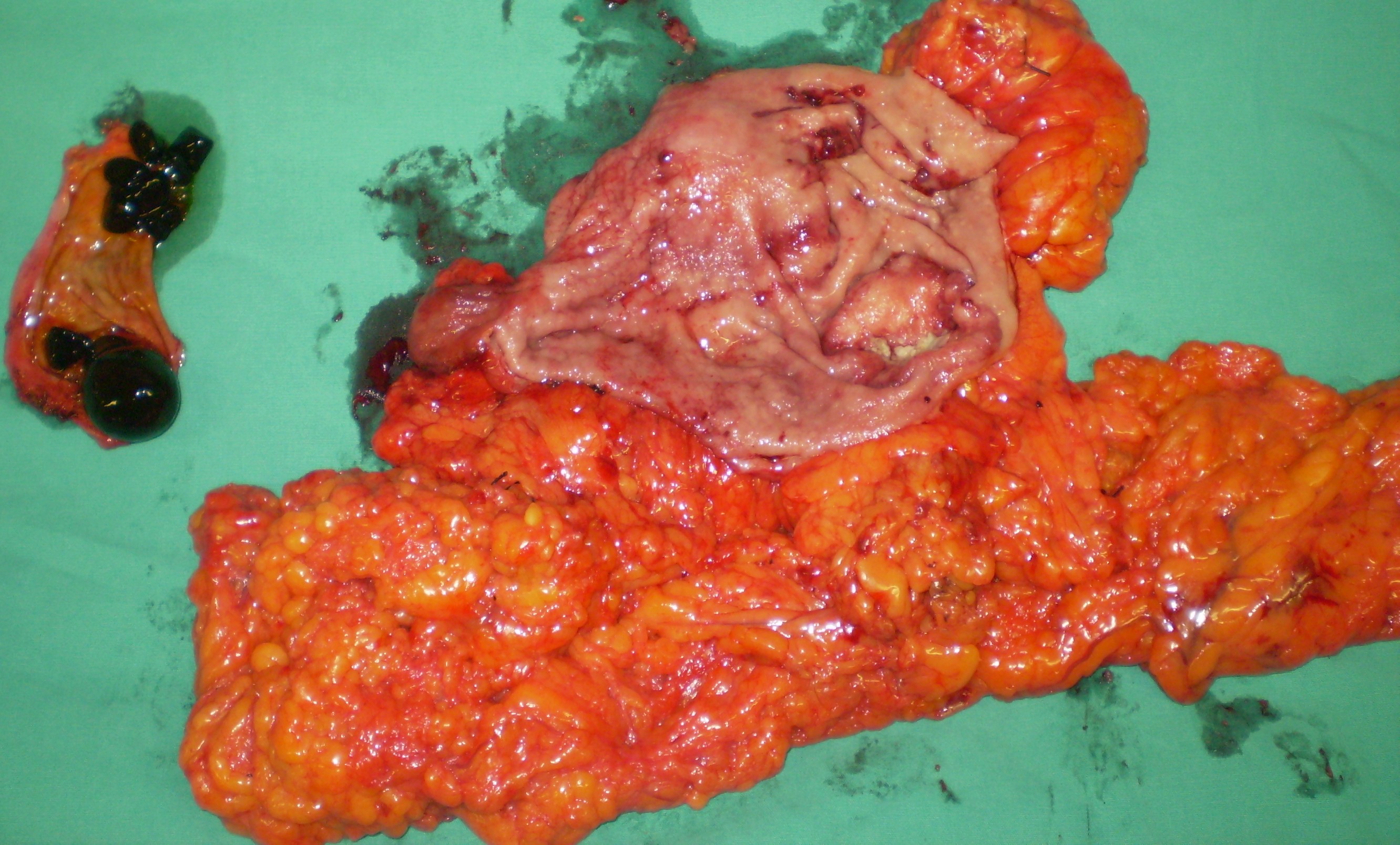 GASTRIC CANCER