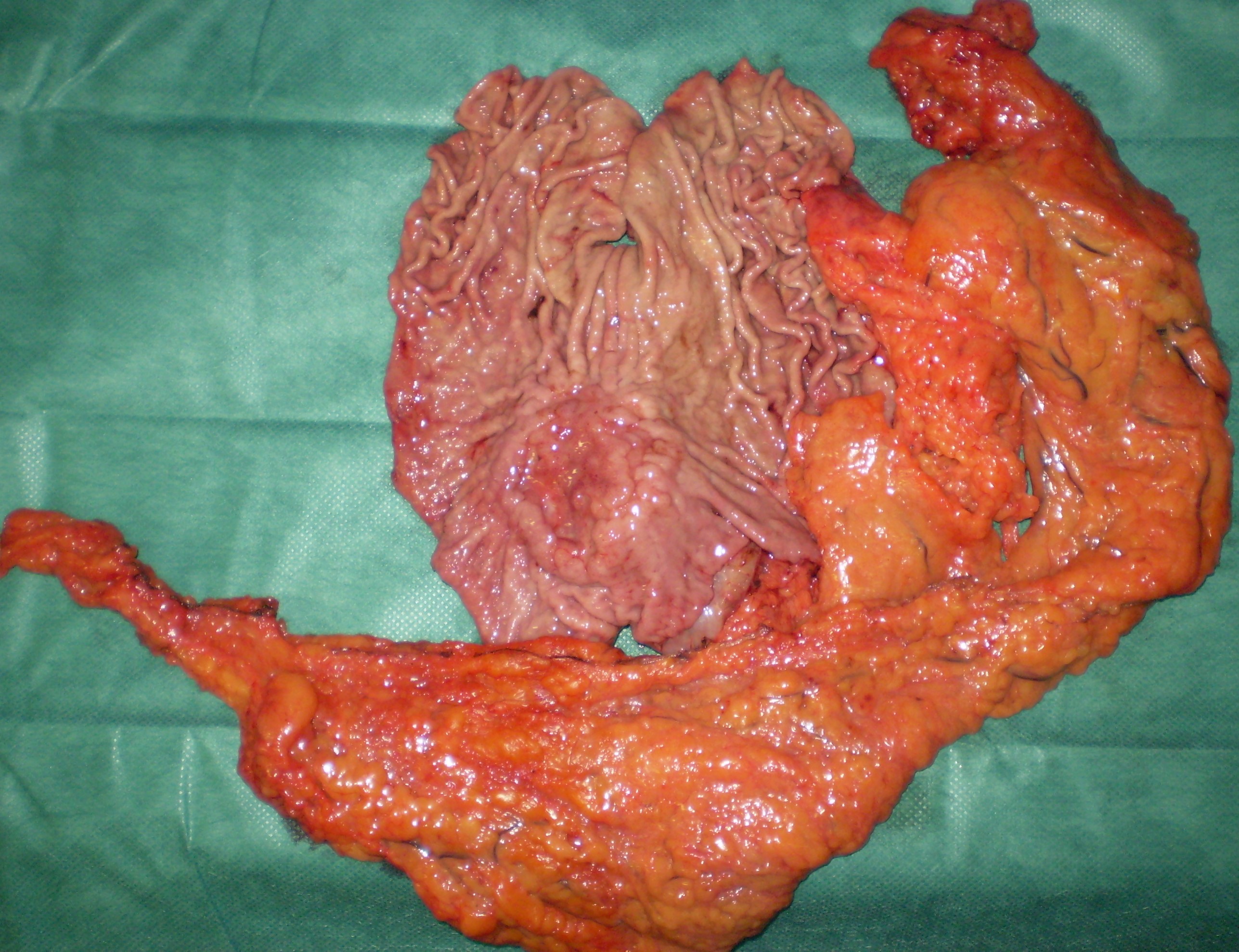GASTRIC CANCER