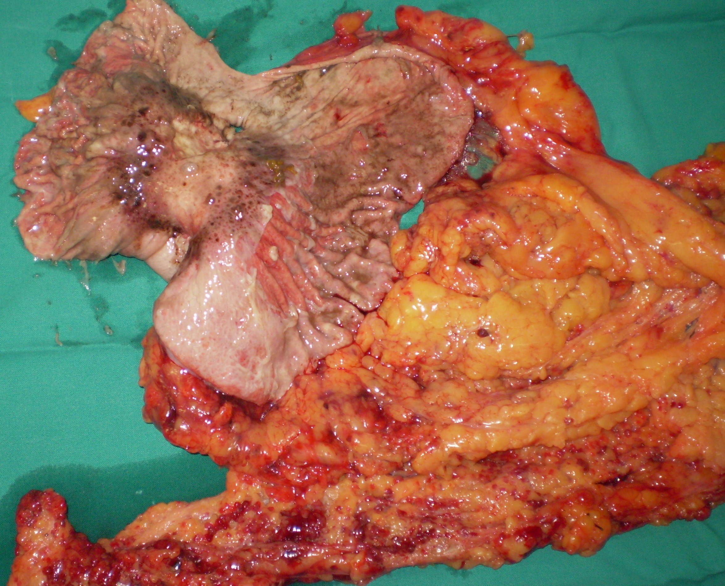 GASTRIC CANCER