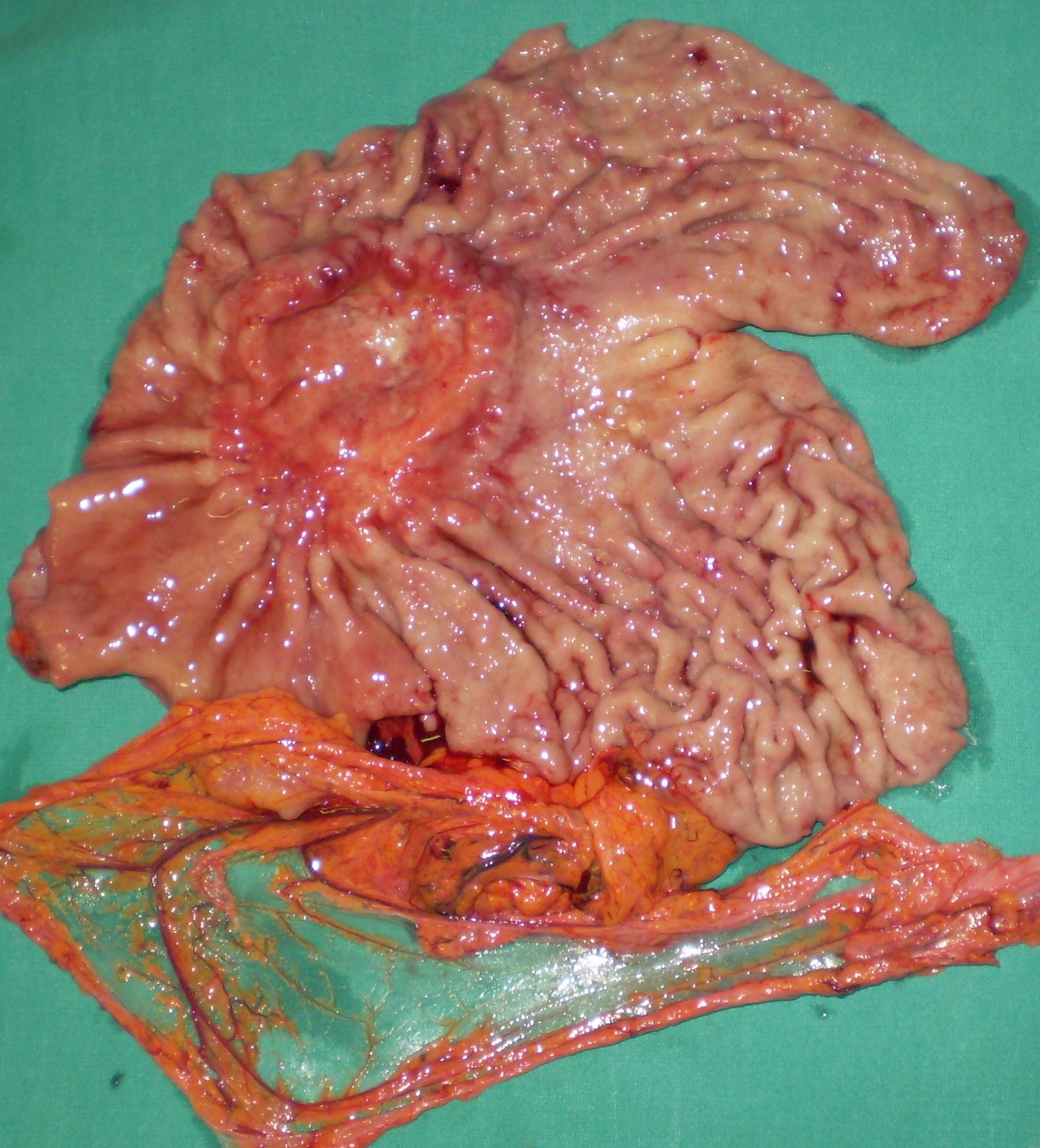 GASTRIC CANCER