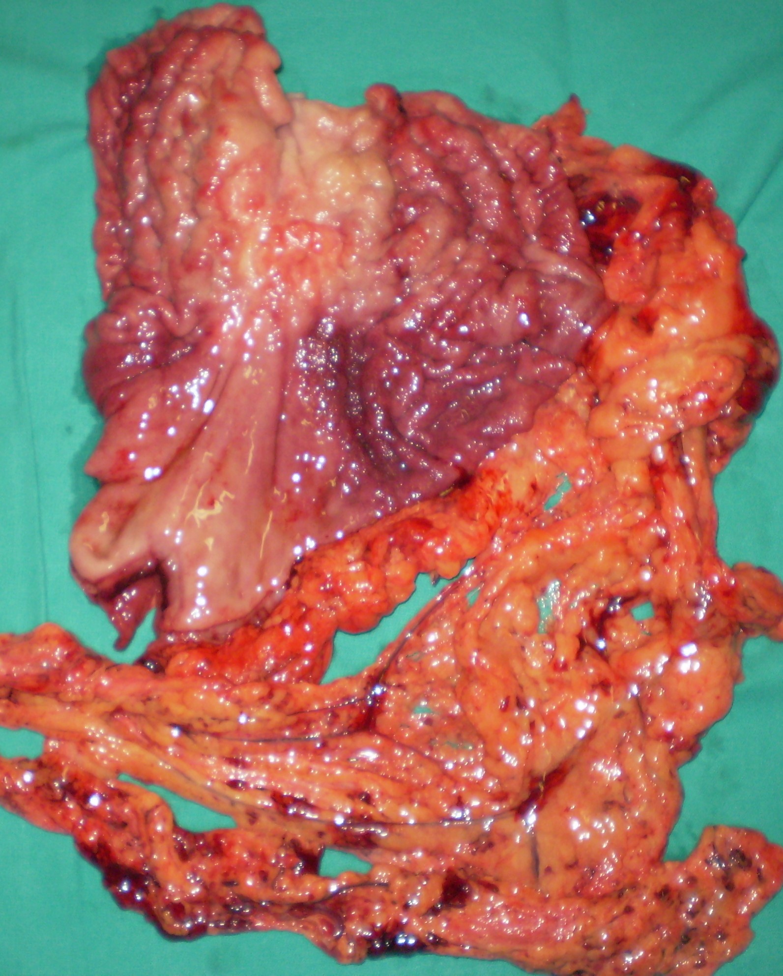 GASTRIC CANCER