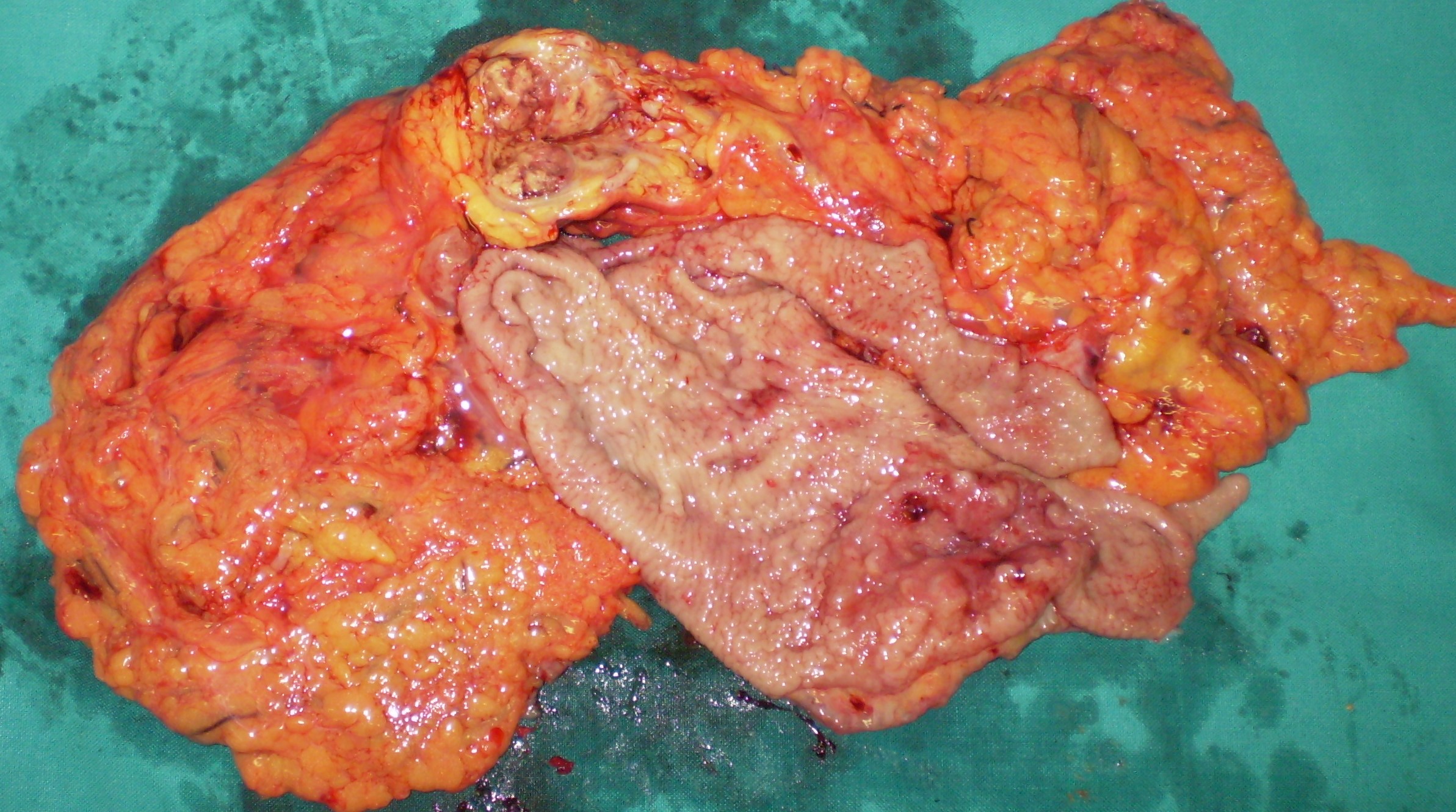 GASTRIC CANCER