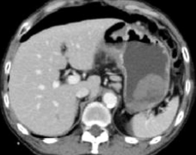 PERFORATED GASTRIC CANCER