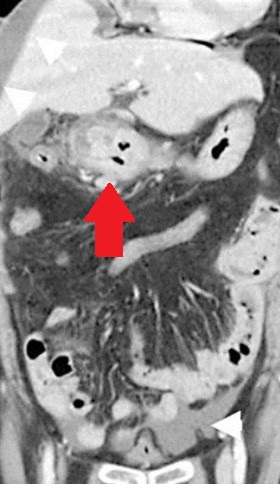 PERFORATED GASTRIC PANCREAS