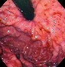 PORTAL GASTROPATHY