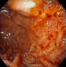PORTAL GASTROPATHY