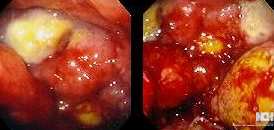 PREPYLORIC GASTRIC CARCINOMA