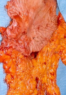 PREPYLORIC GASTRIC CARCINOMA