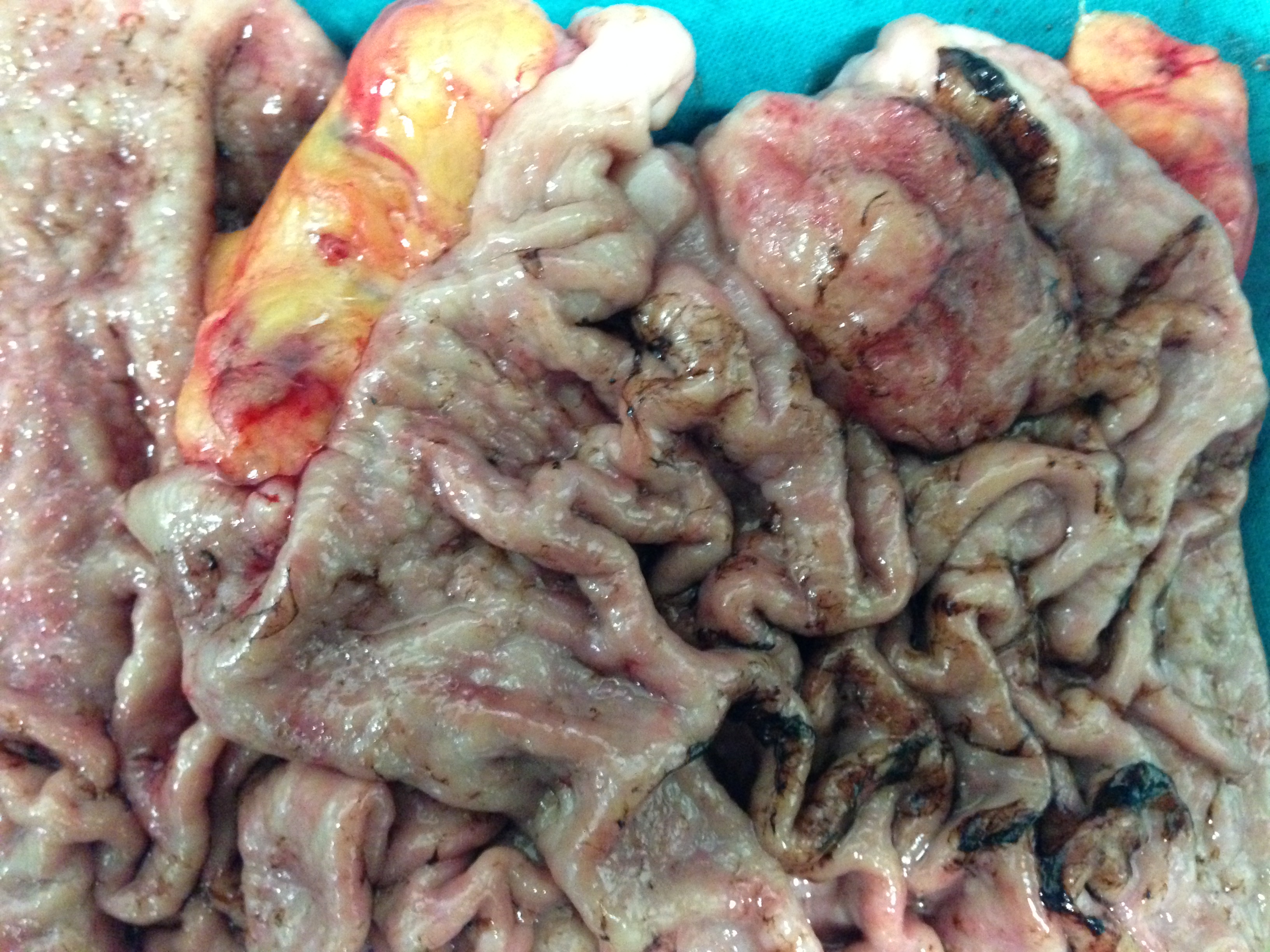 PROXIMAL GASTRECTOMY