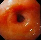 PYLORIC STENOSIS