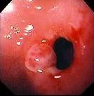 PYLORIC STENOSIS