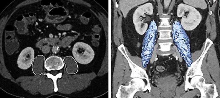SARCOPENIA - PSOAS PERIMETER