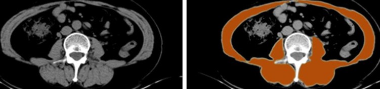 SARCOPENIA - PSOAS PERIMETER 