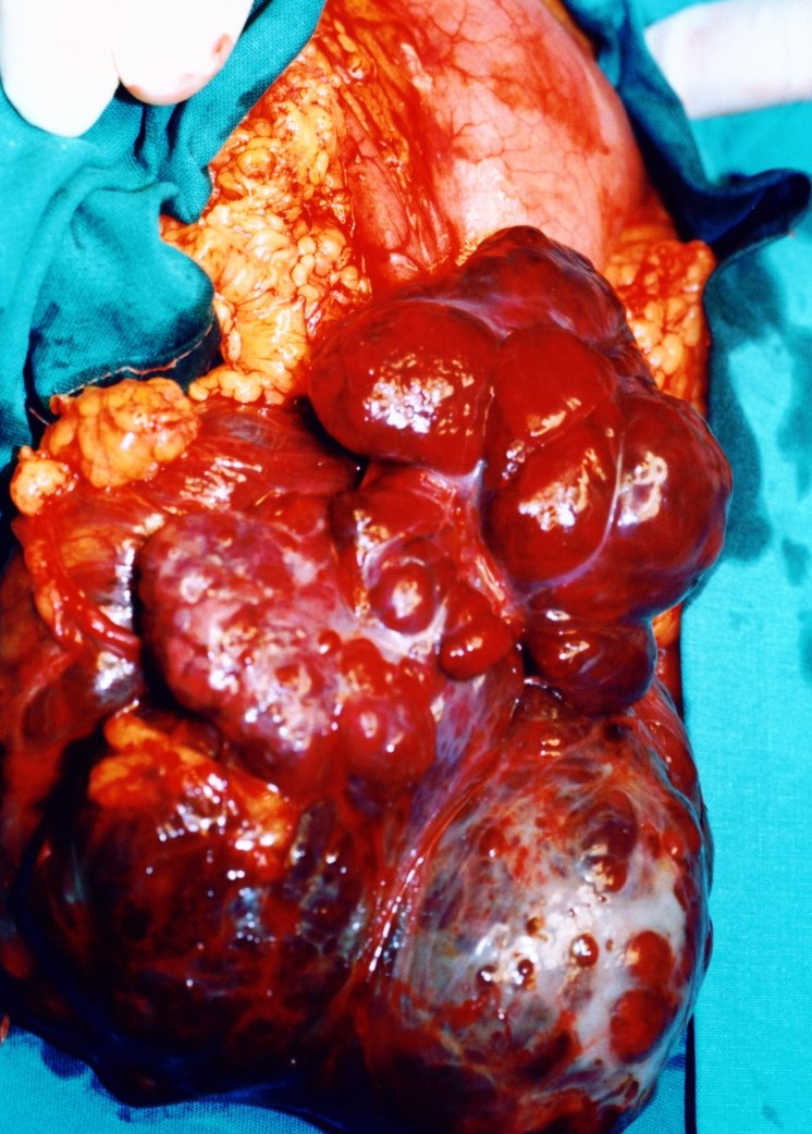 GASTRIC GIST